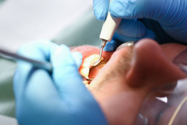 Best Broken or Cracked Tooth Emergency Dentist in Fort Mill, SC